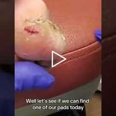 A Doctor’s First Step to Healing a Diabetic Wound 🩹🦶